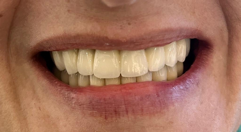 Transformacija Zuba 01 Posle | Dental Lazarević