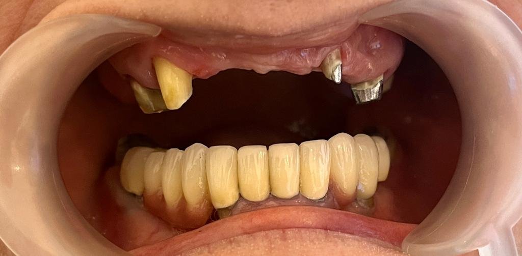 Transformacija Zuba 01 Pre | Dental Lazarević