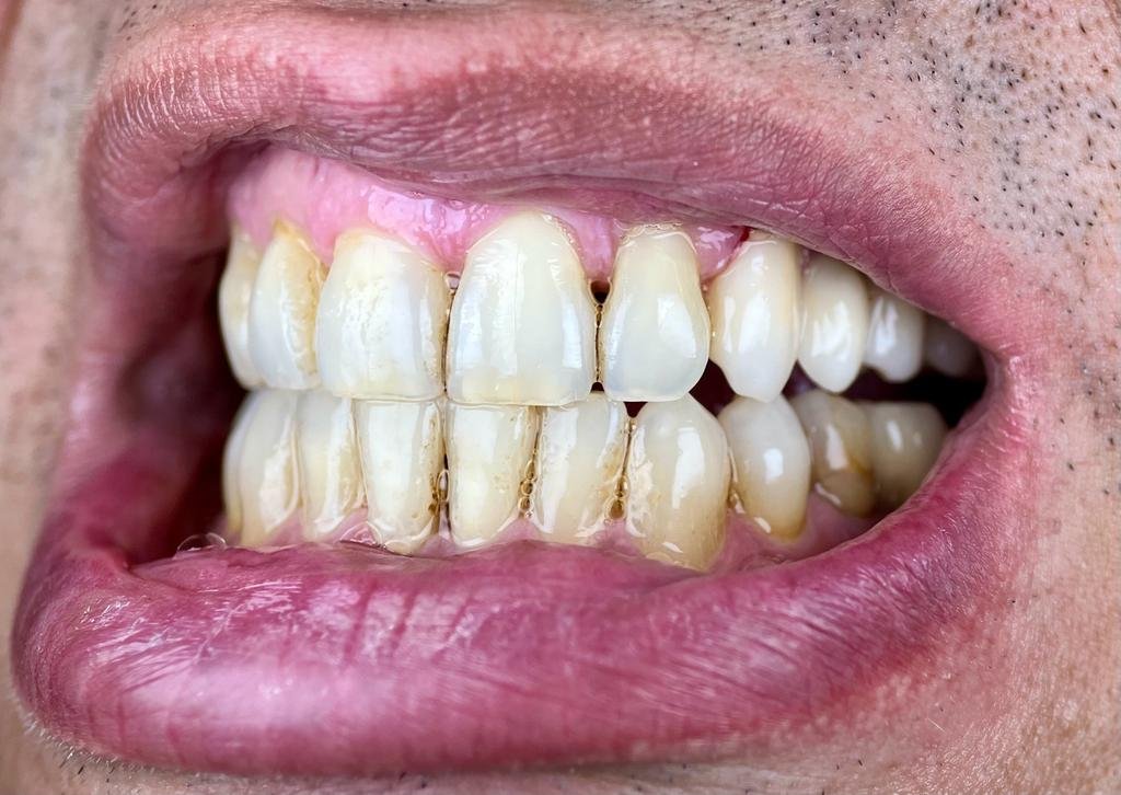 Transformacija Zuba 02 Posle | Dental Lazarević