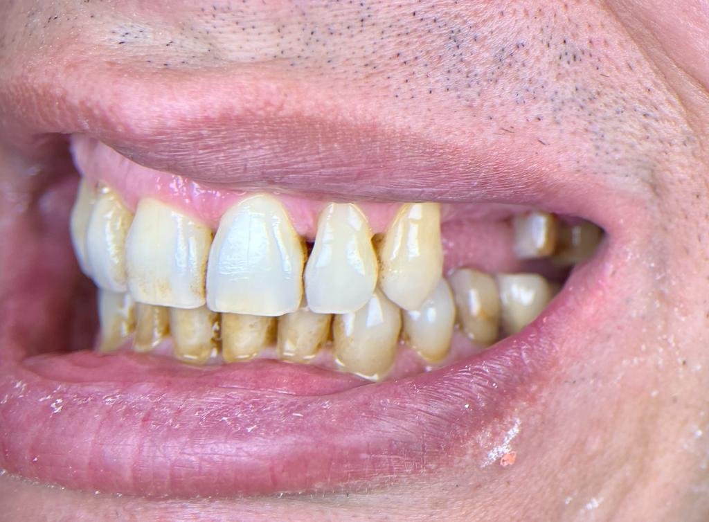 Transformacija Zuba 02 Pre | Dental Lazarević