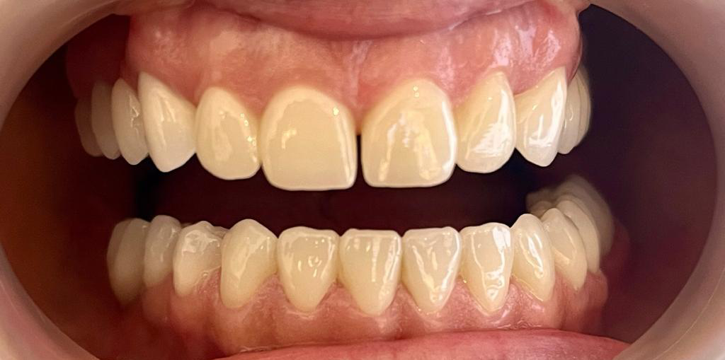 Transformacija Zuba 03 Posle | Dental Lazarević