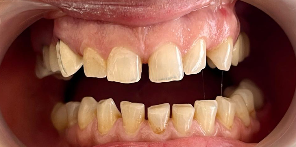 Transformacija Zuba 03 Pre | Dental Lazarević