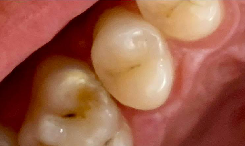 Transformacija Zuba 04 Posle | Dental Lazarević