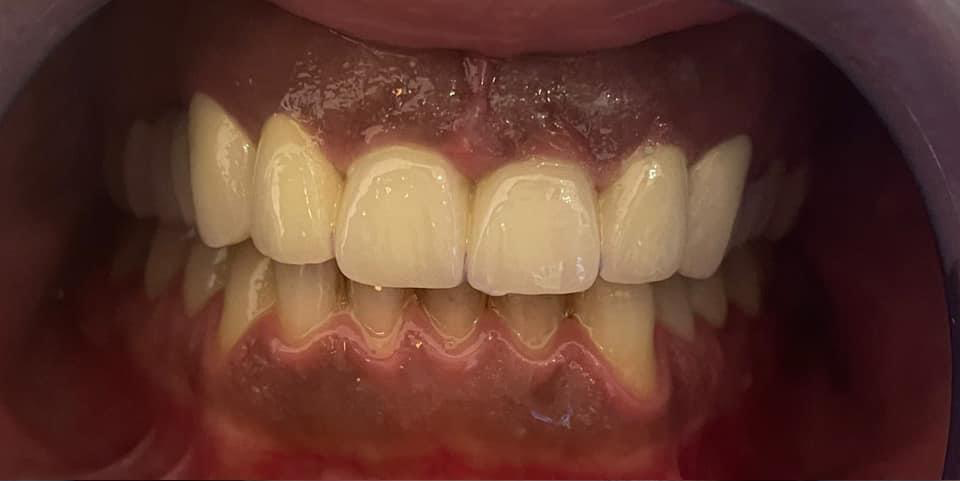 Transformacija Zuba 05 Posle | Dental Lazarević