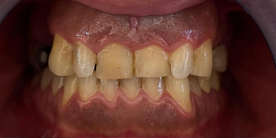 Transformacija Zuba 05 Pre | Dental Lazarević