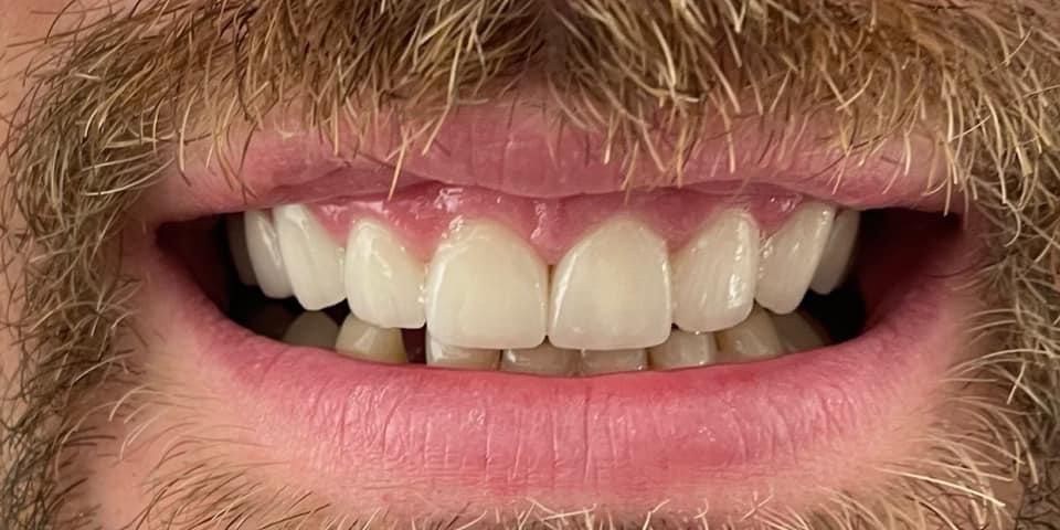 Transformacija Zuba 06 Posle | Dental Lazarević