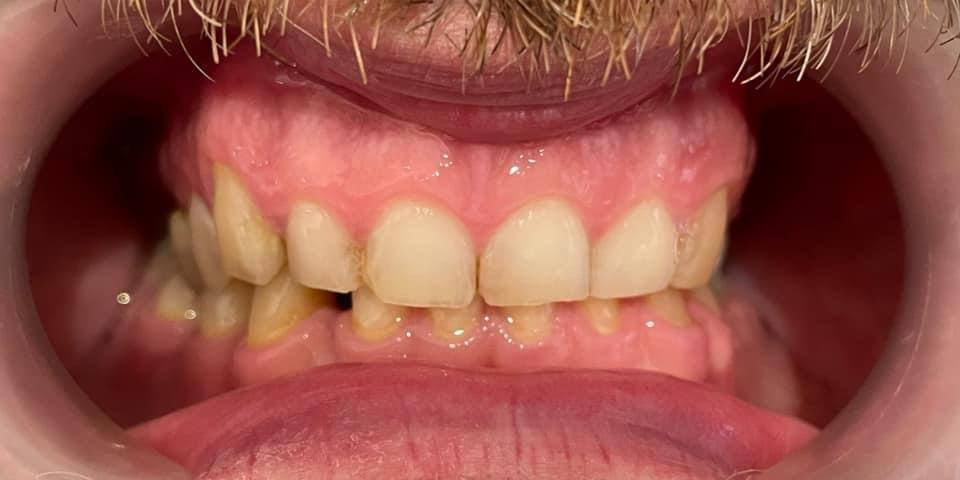 Transformacija Zuba 06 Pre | Dental Lazarević