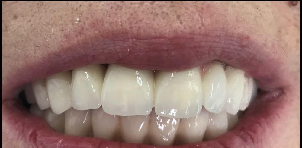 Transformacija Zuba 07 Posle | Dental Lazarević