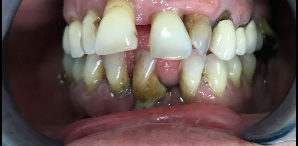 Transformacija Zuba 07 Pre | Dental Lazarević