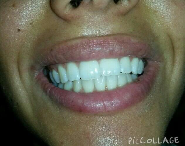 Transformacija Zuba 08 Posle | Dental Lazarević