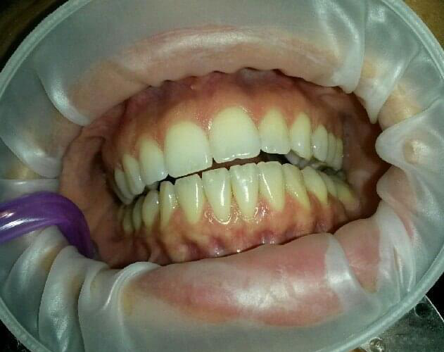 Transformacija Zuba 08 Pre | Dental Lazarević