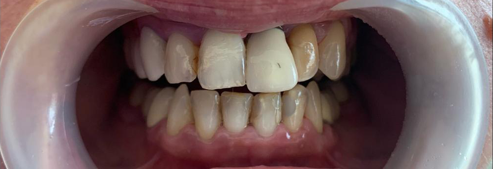 Transformacija Zuba 09 Pre | Dental Lazarević
