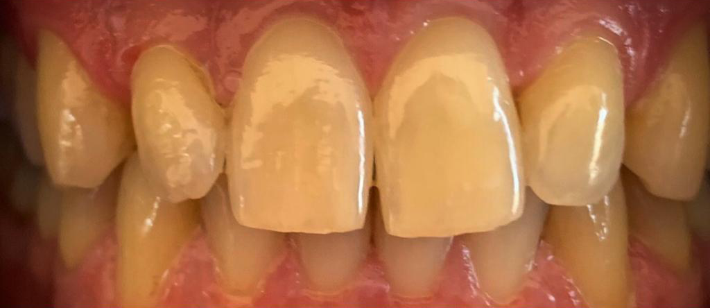 Transformacija Zuba 10 Pre | Dental Lazarević