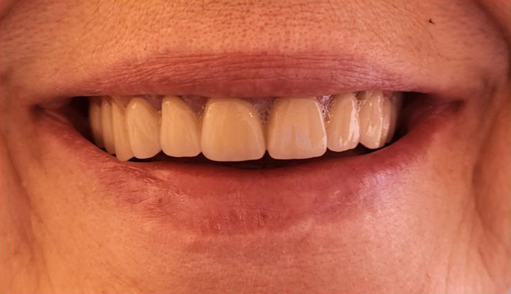 Transformacija Zuba 11 Posle | Dental Lazarević