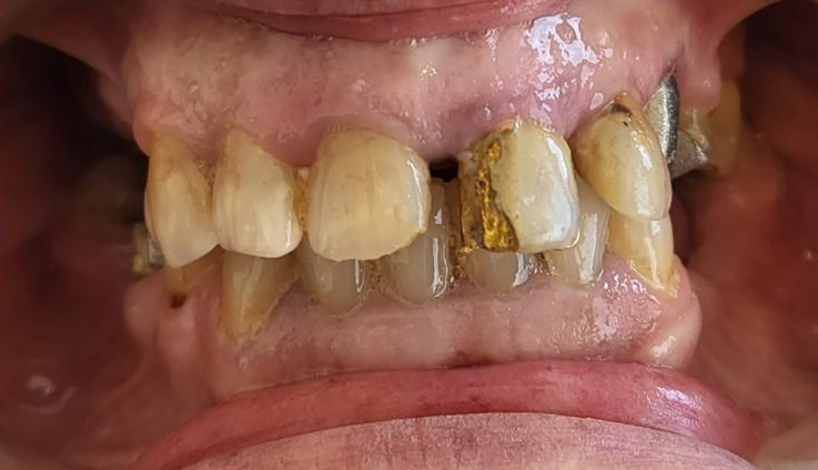 Transformacija Zuba 11 Pre | Dental Lazarević