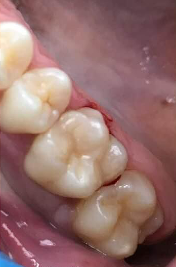 Transformacija Zuba 13 Posle | Dental Lazarević