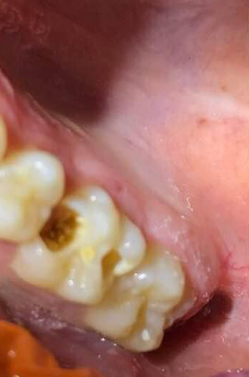 Transformacija Zuba 13 Pre | Dental Lazarević