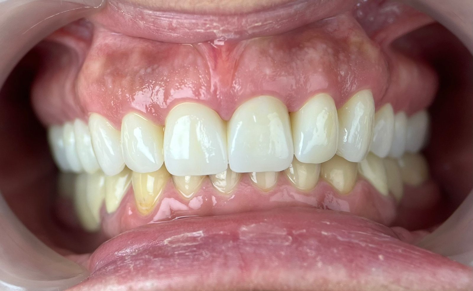 Transformacija Zuba 15 Posle | Dental Lazarević
