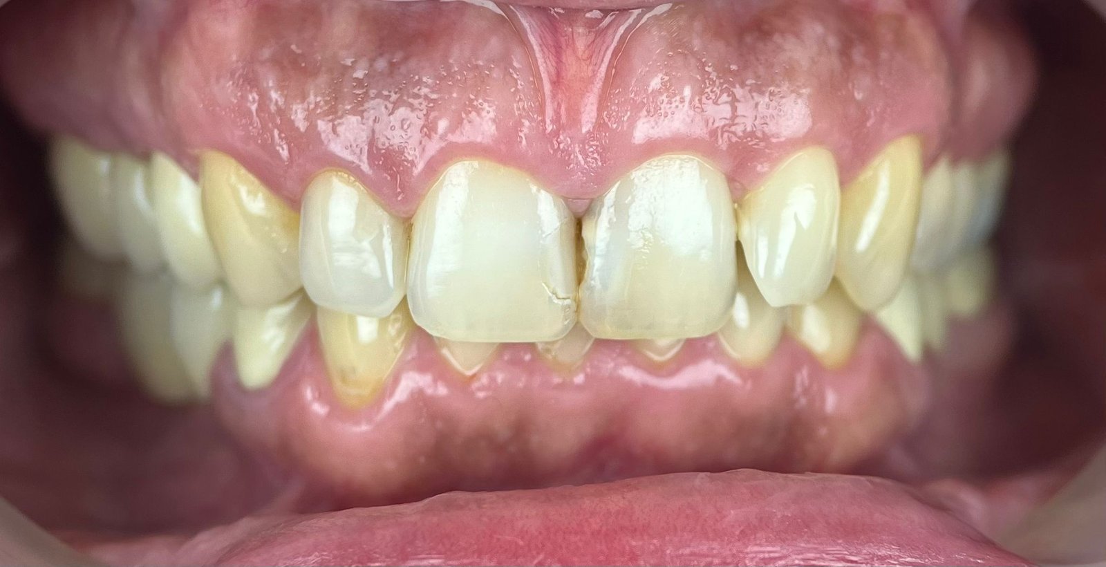 Transformacija Zuba 15 Pre | Dental Lazarević