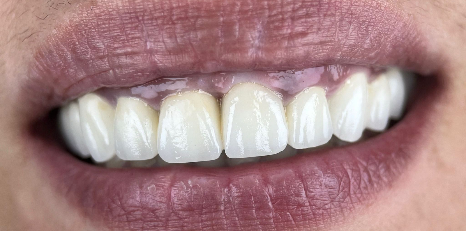 Transformacija Zuba 16 Posle | Dental Lazarević