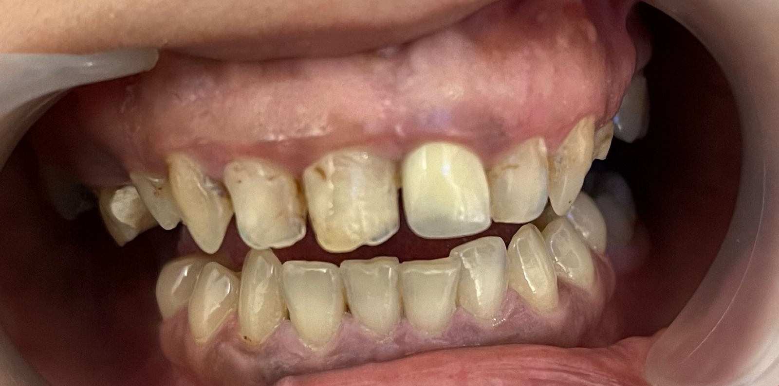 Transformacija Zuba 16 Pre | Dental Lazarević