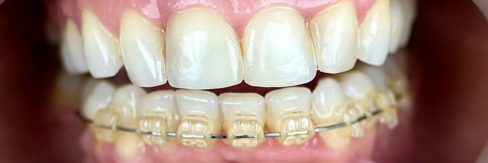Transformacija Zuba 17 Posle | Dental Lazarević