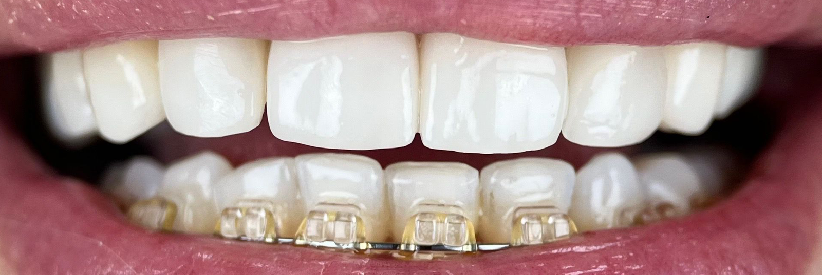 Transformacija Zuba 17 Pre | Dental Lazarević