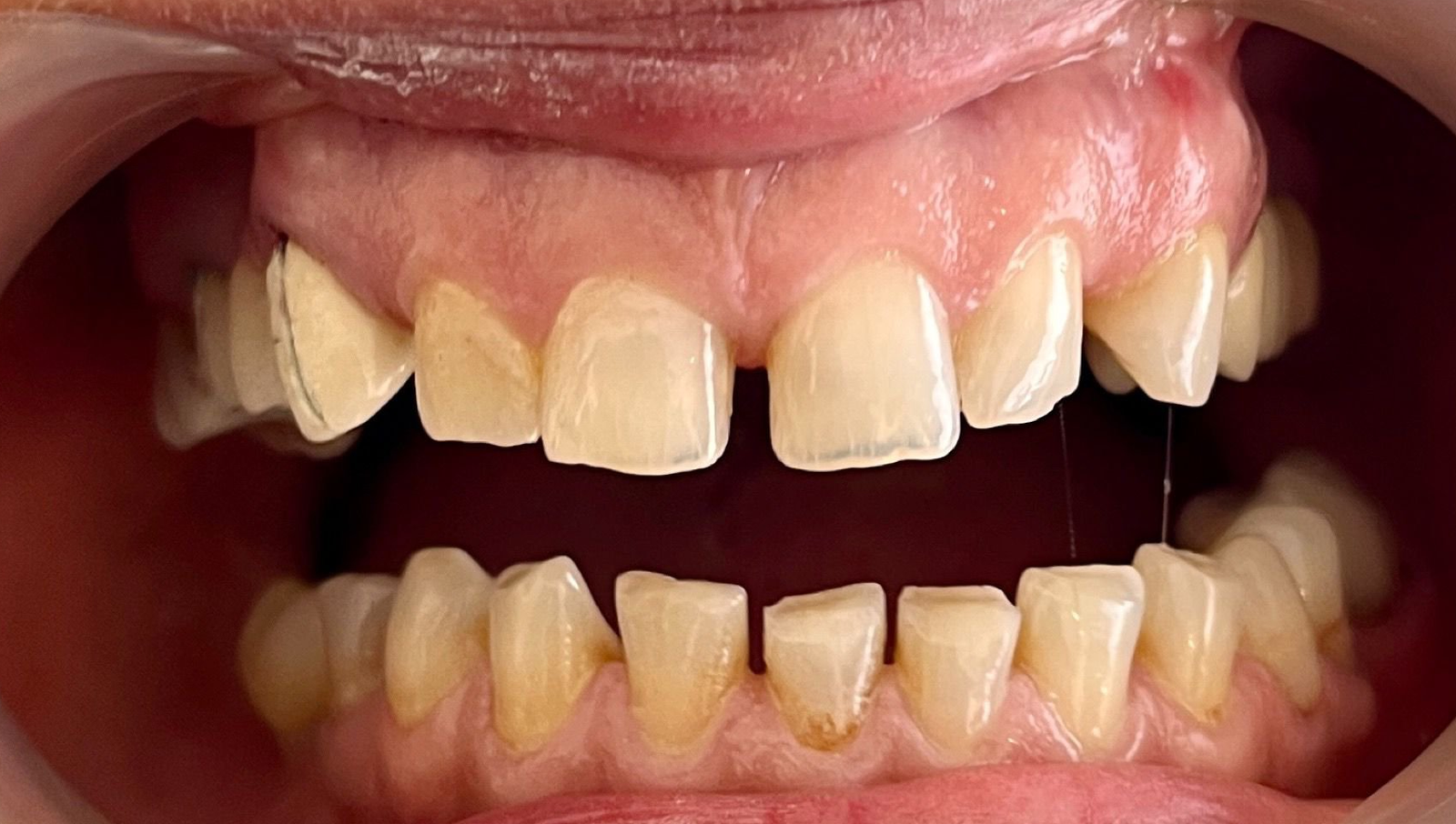 Transformacija Zuba 19 Posle | Dental Lazarević