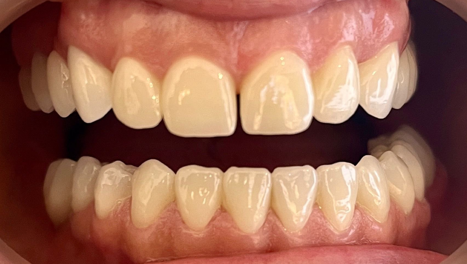 Transformacija Zuba 19 Pre | Dental Lazarević
