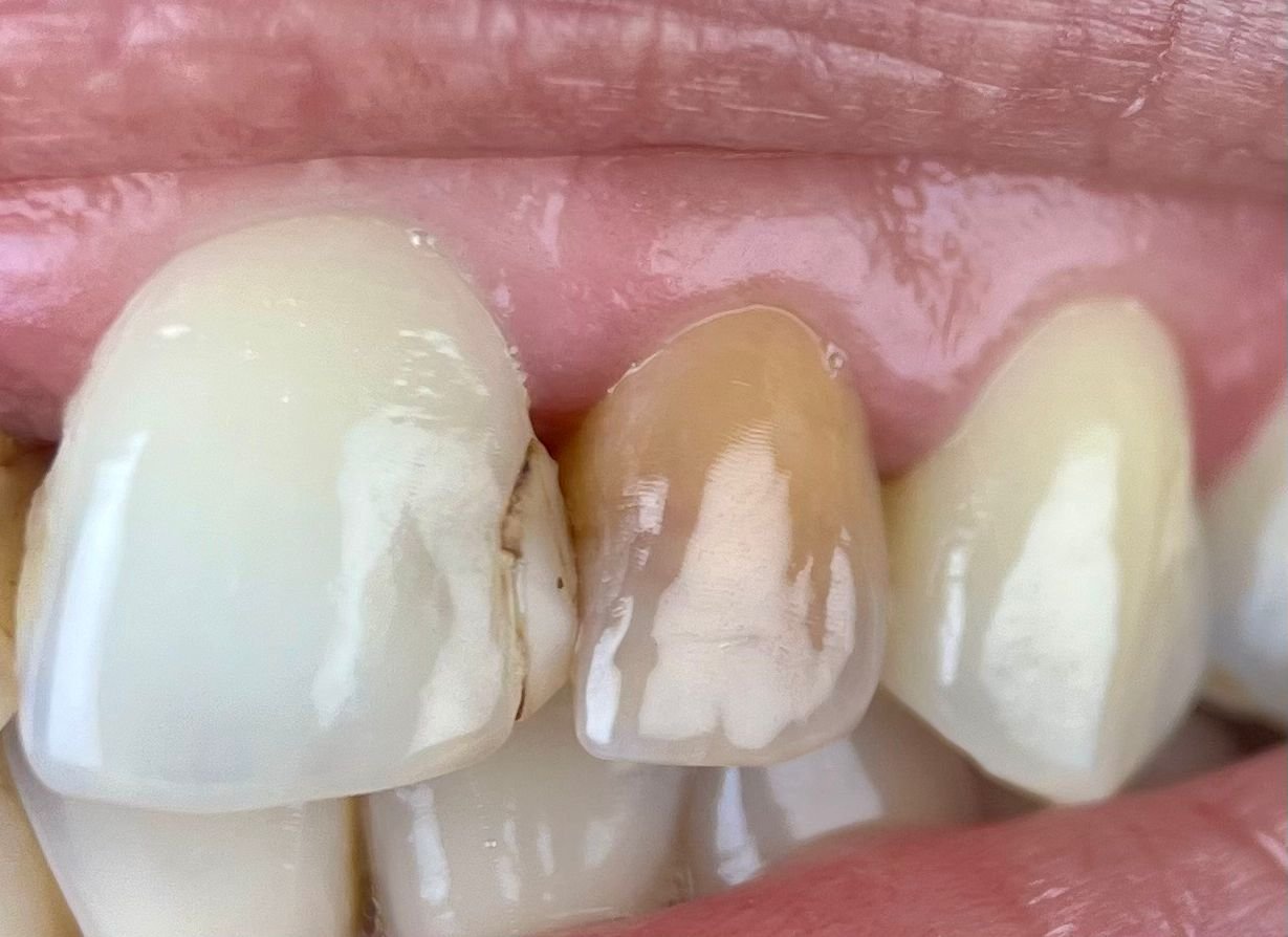 Transformacija Zuba 21 Posle | Dental Lazarević