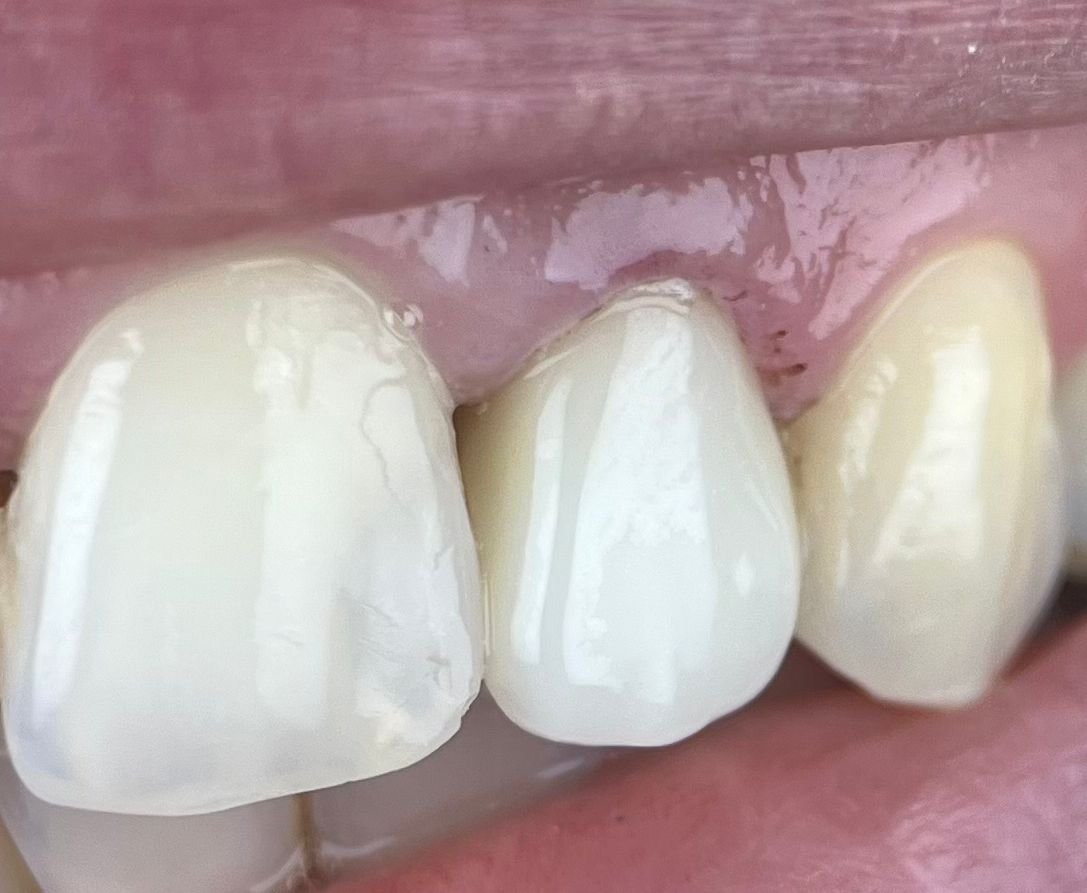 Transformacija Zuba 21 Pre | Dental Lazarević
