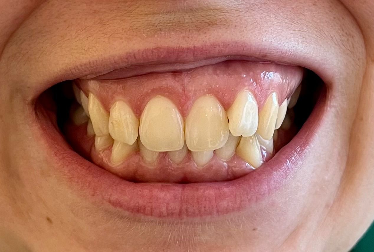 Transformacija Zuba 22 Posle | Dental Lazarević