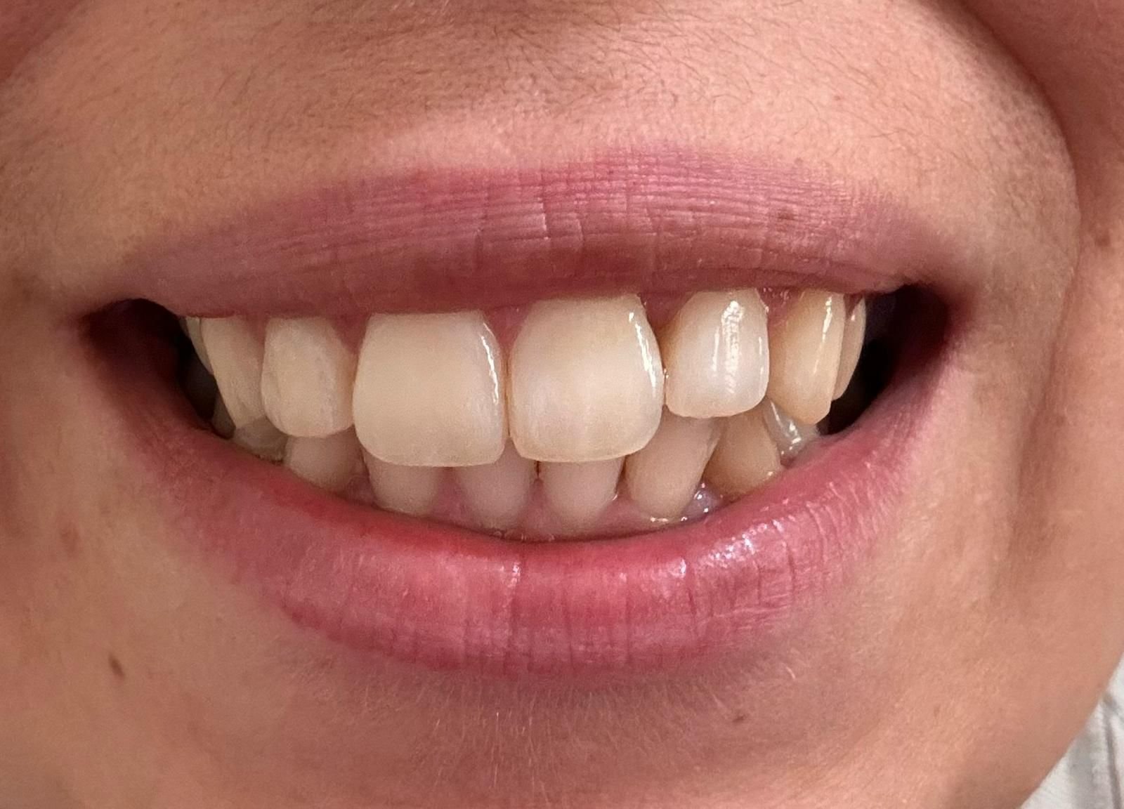 Transformacija Zuba 22 Pre | Dental Lazarević