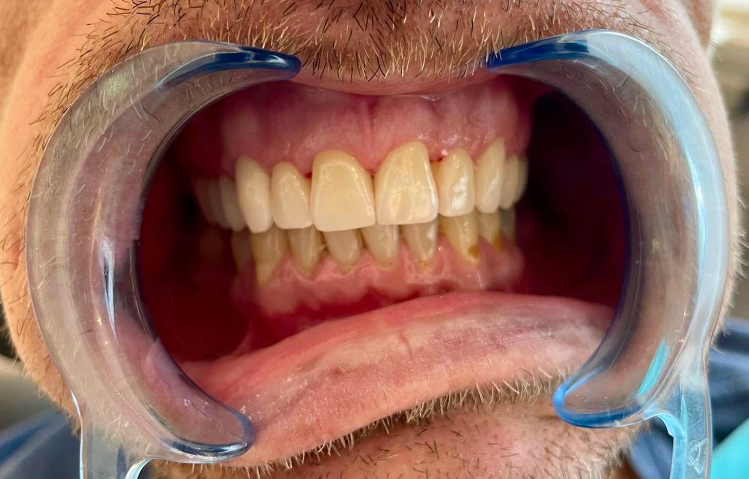 Transformacija Zuba 24 Posle | Dental Lazarević
