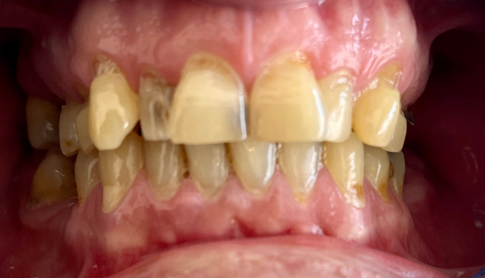 Transformacija Zuba 24 Pre | Dental Lazarević