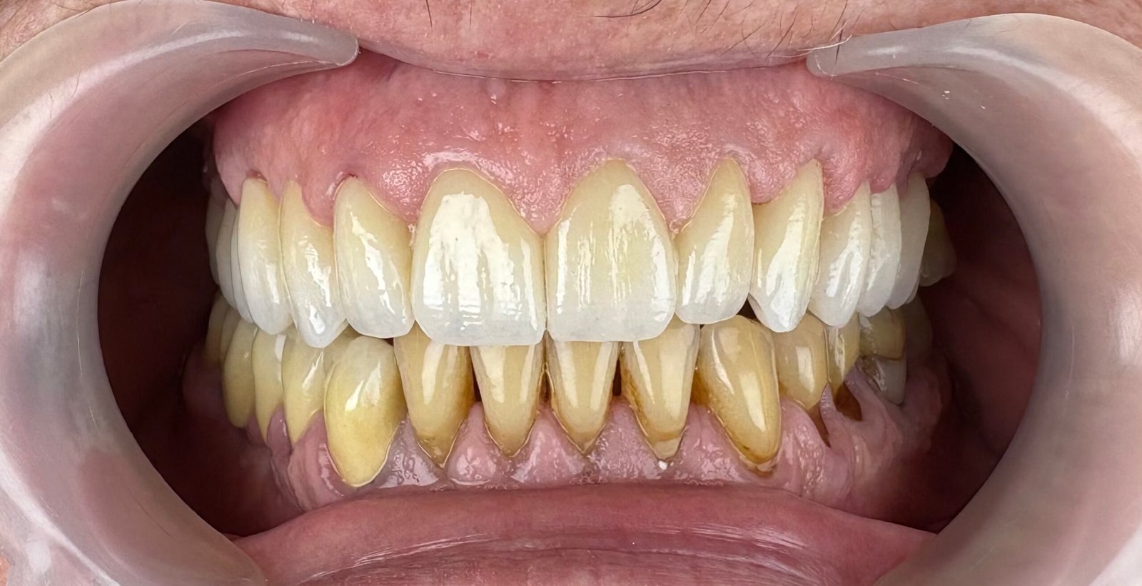 Transformacija Zuba 25 Posle | Dental Lazarević