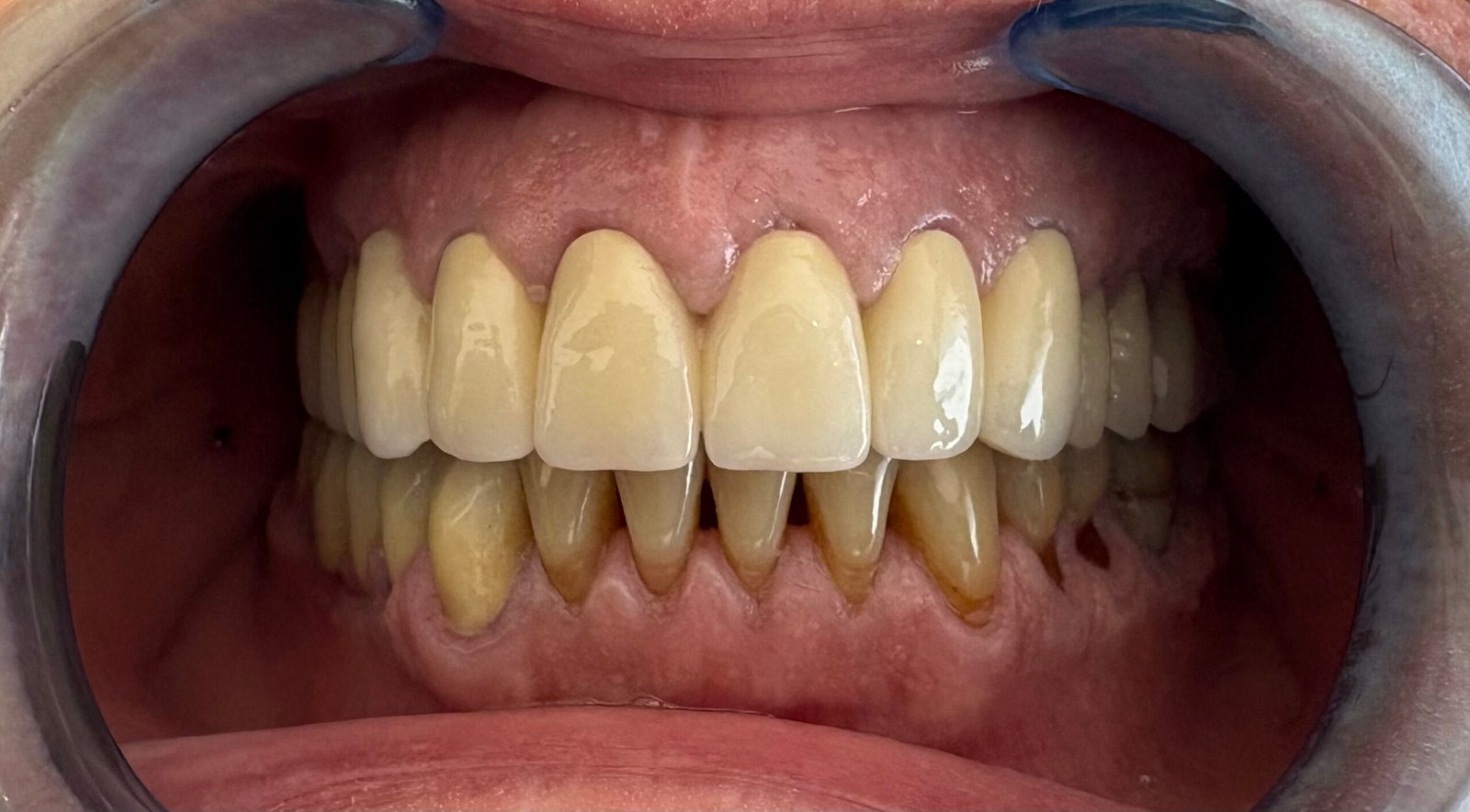Transformacija Zuba 25 Pre | Dental Lazarević