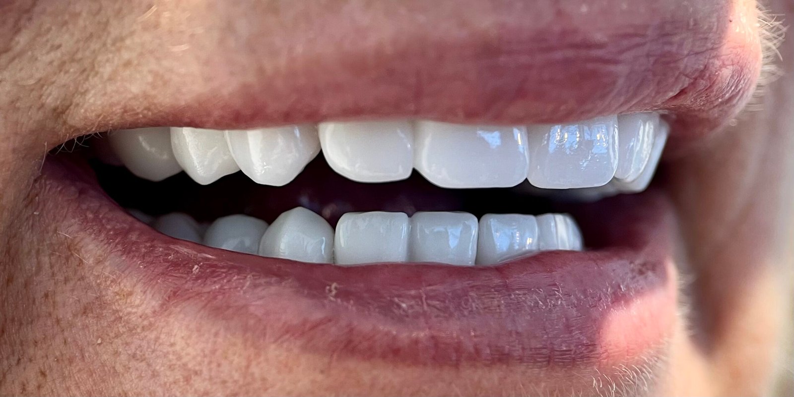 Transformacija Zuba 26 Posle | Dental Lazarević
