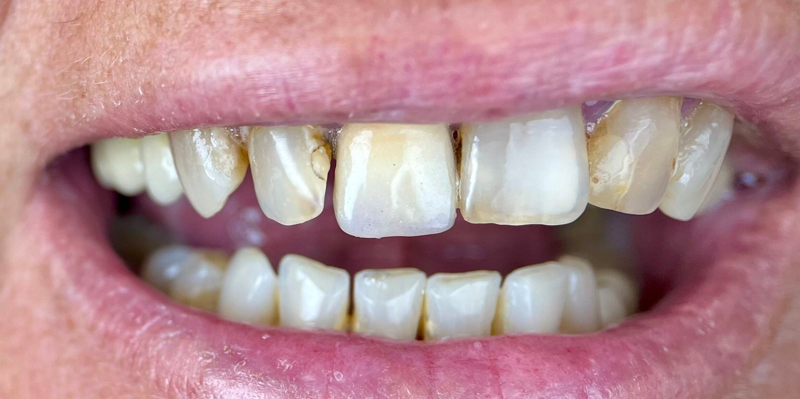 Transformacija Zuba 26 Pre | Dental Lazarević