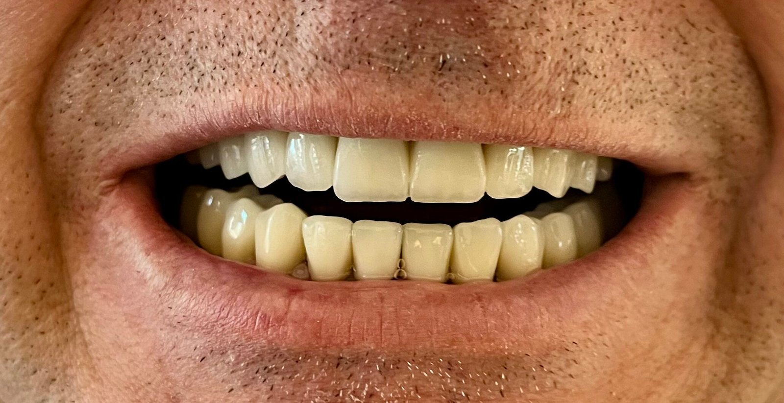 Transformacija Zuba 27 Posle | Dental Lazarević