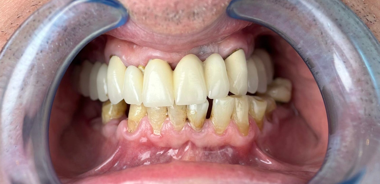 Transformacija Zuba 27 Pre | Dental Lazarević