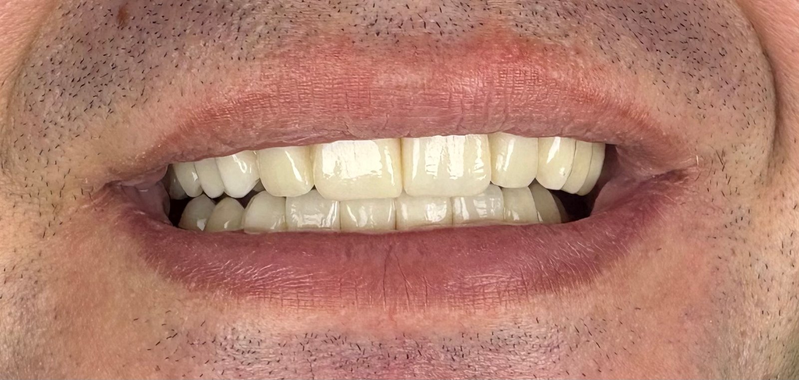 Transformacija Zuba 28 Posle | Dental Lazarević