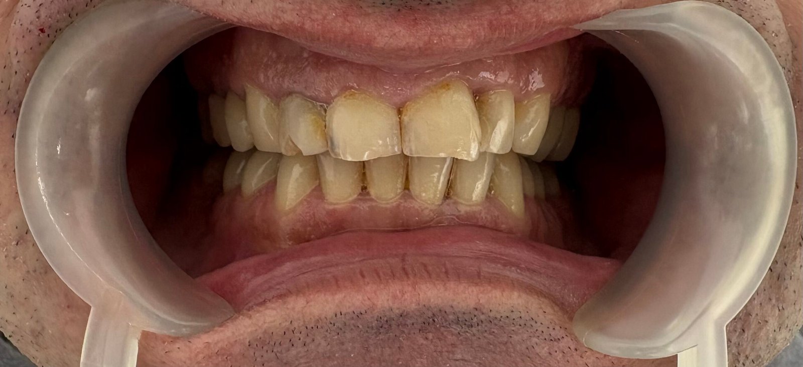 Transformacija Zuba 28 Pre | Dental Lazarević