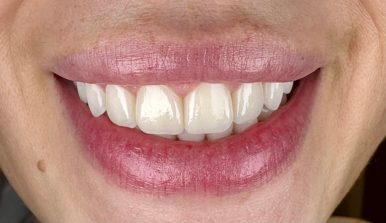 Transformacija Zuba 29 Posle | Dental Lazarević