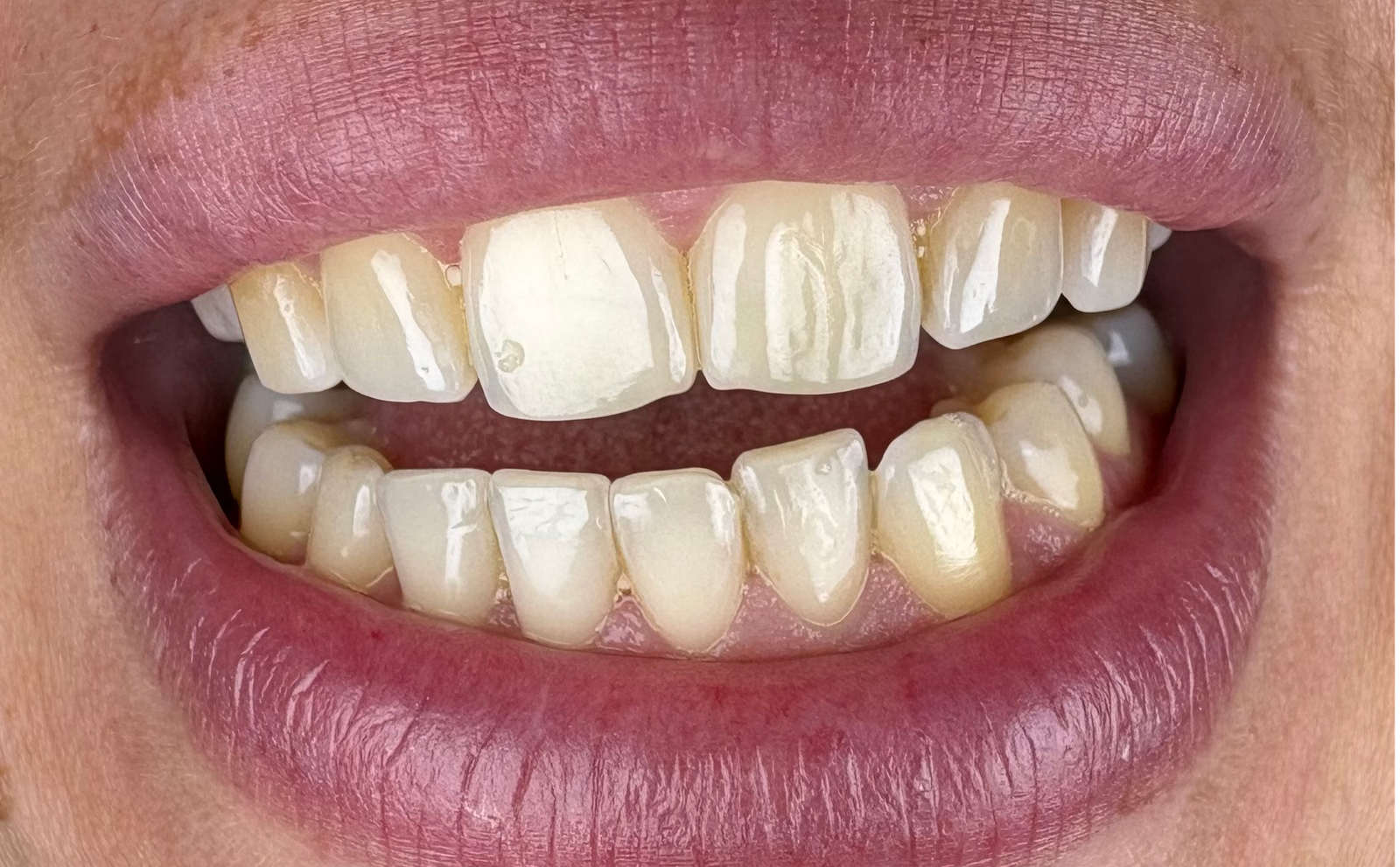 Transformacija Zuba 29 Pre | Dental Lazarević